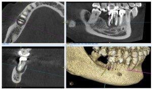 Le Cone Beam ou CBCT (Radiologie)